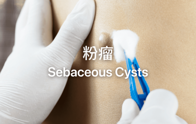 Sebaceous Cysts